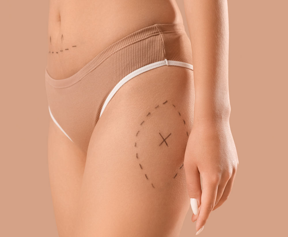 Oberschenkelstraffung in Mannheim