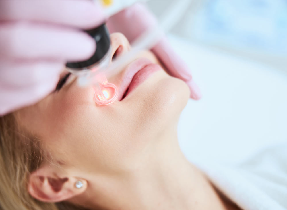 CO2 Laserbehandlung in Mannheim