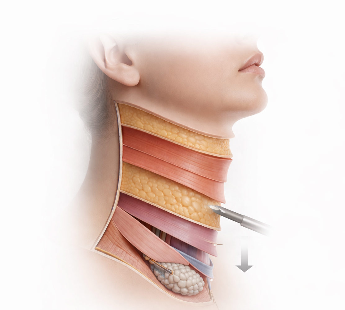 Deep Neck Lift Anschauung
